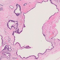 気管支性嚢胞